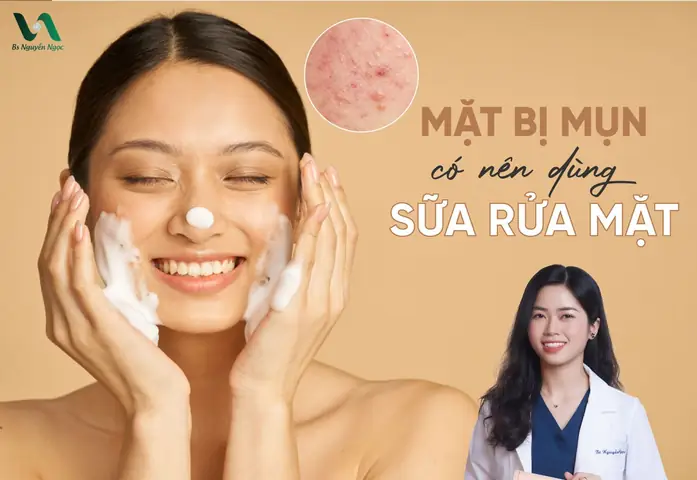 Bị Mụn Có Nên Dùng Sữa Rửa Mặt Không? Nguyên Nhân & Cách Khắc Phục Bị Mụn Có Nên Dùng Sữa Rửa Mặt Không? Nguyên Nhân & Cách Khắc Phục