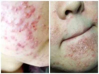 Bị Mụn Có Nên Dùng Sữa Rửa Mặt Không? Nguyên Nhân & Cách Khắc Phục Bị Mụn Có Nên Dùng Sữa Rửa Mặt Không? Nguyên Nhân & Cách Khắc Phục