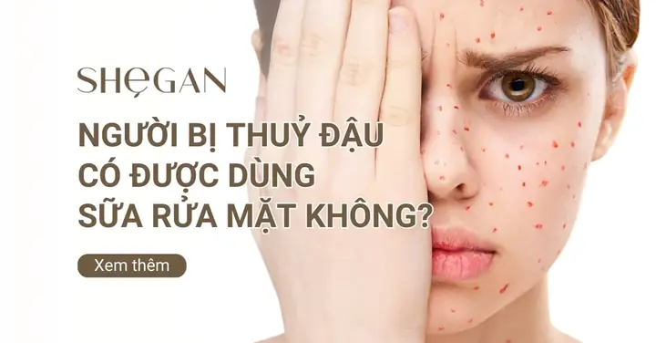 Bị Thủy Đậu Có Được Dùng Sữa Rửa Mặt Không? Lời Khuyên Từ Chuyên Gia