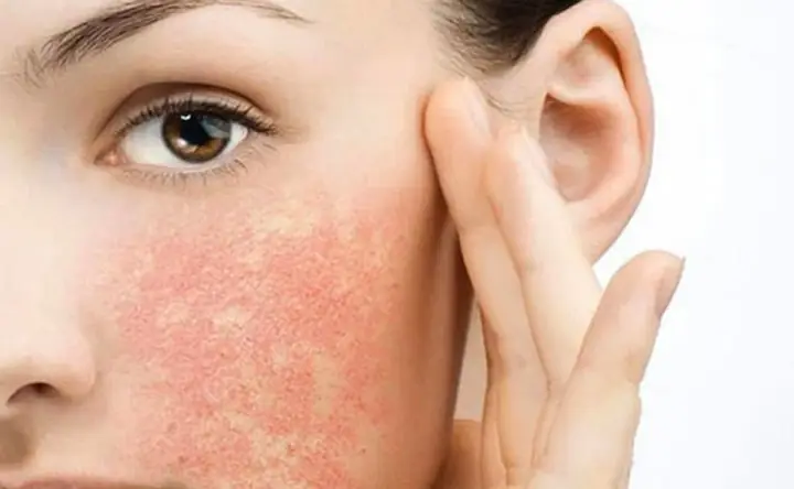 Cách Xử Lý Khi Bị Dị Ứng Sữa Rửa Mặt: Dấu Hiệu, Nguyên Nhân & Biện Pháp Khắc Phục Hiệu Quả Cách Xử Lý Khi Bị Dị Ứng Sữa Rửa Mặt: Dấu Hiệu, Nguyên Nhân & Biện Pháp Khắc Phục Hiệu Quả
