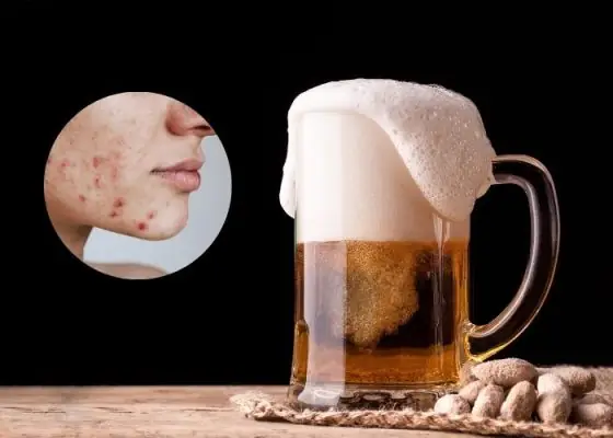 Rửa Mặt Bằng Bia Trị Mụn: Cách Thực Hiện, Tác Dụng Và Lưu Ý Quan Trọng