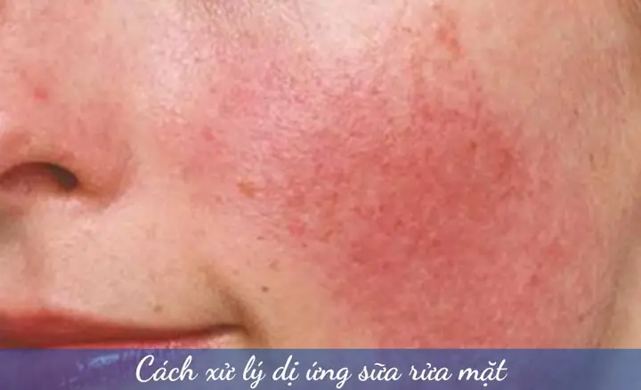 Cách Xử Lý & Chăm Sóc Da Khi Bị Dị Ứng Sữa Rửa Mặt Hiệu Quả Cách Xử Lý & Chăm Sóc Da Khi Bị Dị Ứng Sữa Rửa Mặt Hiệu Quả