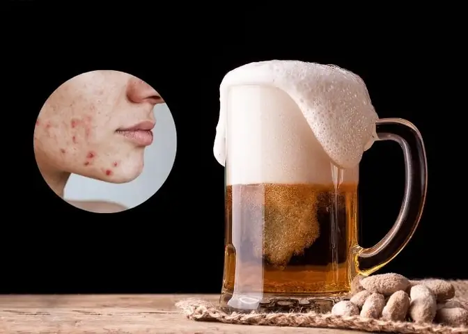 Có Nên Rửa Mặt Bằng Bia Không? Tác Dụng, Cách Làm Và Lưu Ý