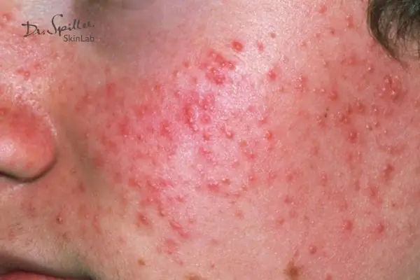 Da Mặt Bị Mẩn Đỏ Sau Khi Rửa Mặt: Nguyên Nhân, Dấu Hiệu Và Cách Xử Lý Hiệu Quả Da Mặt Bị Mẩn Đỏ Sau Khi Rửa Mặt: Nguyên Nhân, Dấu Hiệu Và Cách Xử Lý Hiệu Quả