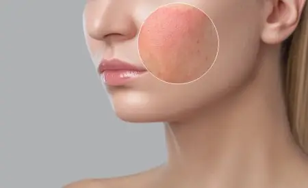 Da Mặt Bị Đỏ Sau Khi Rửa Mặt: Nguyên Nhân, Dấu Hiệu Và Cách Xử Lý Da Mặt Bị Đỏ Sau Khi Rửa Mặt: Nguyên Nhân, Dấu Hiệu Và Cách Xử Lý