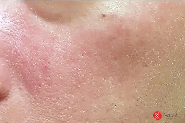 Da Mặt Bị Đỏ Sau Khi Rửa Mặt: Nguyên Nhân, Dấu Hiệu Và Cách Xử Lý Da Mặt Bị Đỏ Sau Khi Rửa Mặt: Nguyên Nhân, Dấu Hiệu Và Cách Xử Lý