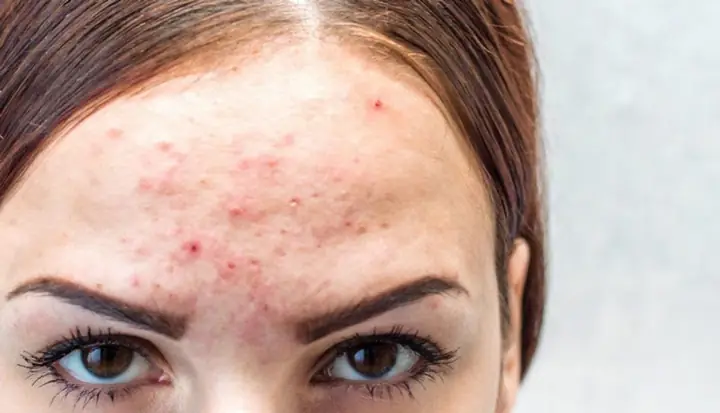 Da Mụn Có Nên Rửa Mặt Bằng Nước Muối Sinh Lý? Hướng Dẫn Và Lưu Ý