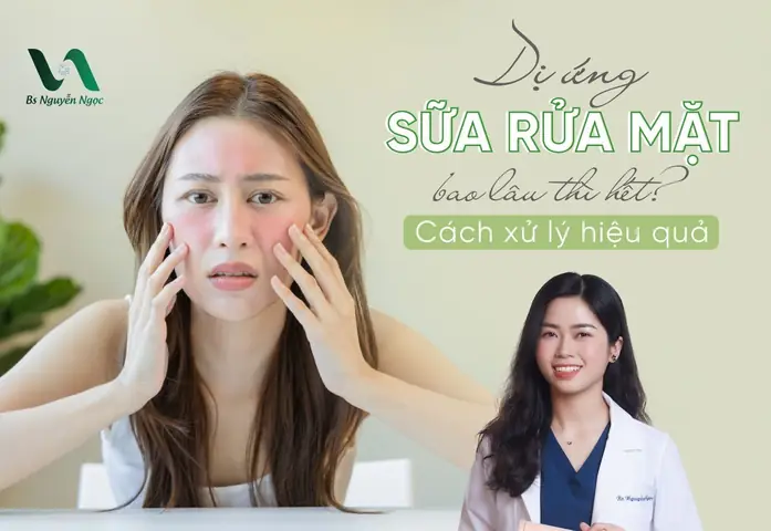 Dị Ứng Sữa Rửa Mặt Bao Lâu Thì Hết Và Cách Xử Lý Hiệu Quả Dị Ứng Sữa Rửa Mặt Bao Lâu Thì Hết Và Cách Xử Lý Hiệu Quả