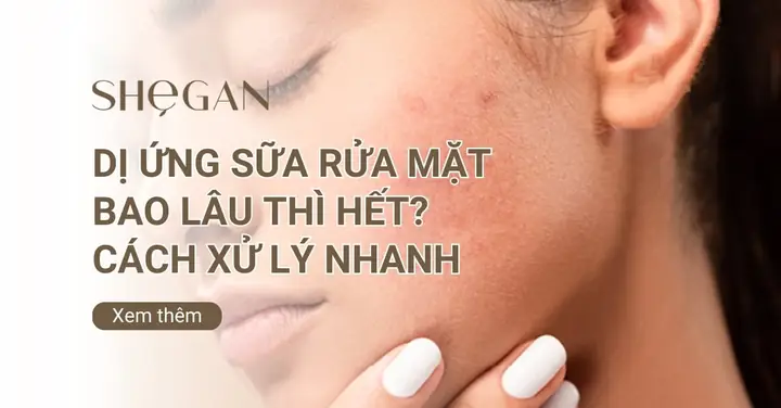 Dị Ứng Sữa Rửa Mặt Bao Lâu Thì Hết Và Cách Xử Lý Hiệu Quả Dị Ứng Sữa Rửa Mặt Bao Lâu Thì Hết Và Cách Xử Lý Hiệu Quả