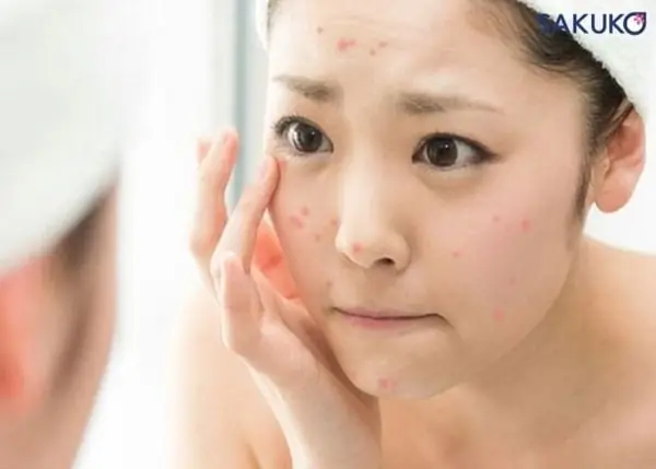 Dị Ứng Sữa Rửa Mặt Bao Lâu Thì Hết Và Cách Xử Lý Hiệu Quả Dị Ứng Sữa Rửa Mặt Bao Lâu Thì Hết Và Cách Xử Lý Hiệu Quả