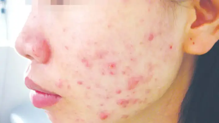 Dị Ứng Sữa Rửa Mặt Phải Làm Sao: Dấu Hiệu, Nguyên Nhân & Cách Xử Lý Nhanh Tại Nhà Dị Ứng Sữa Rửa Mặt Phải Làm Sao: Dấu Hiệu, Nguyên Nhân & Cách Xử Lý Nhanh Tại Nhà