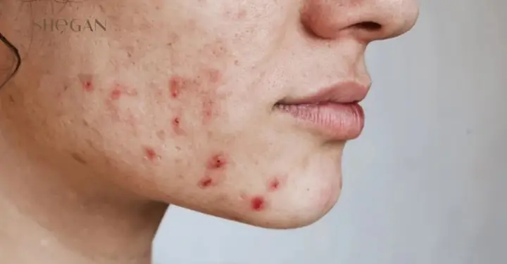 Dùng Sữa Rửa Mặt Hết Hạn Có Sao Không? Tác Hại & Cách Xử Lý An Toàn Dùng Sữa Rửa Mặt Hết Hạn Có Sao Không? Tác Hại & Cách Xử Lý An Toàn