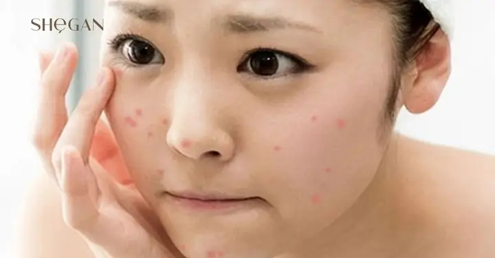 Dùng Sữa Rửa Mặt Hết Hạn Có Sao Không? Tác Hại & Cách Xử Lý An Toàn Dùng Sữa Rửa Mặt Hết Hạn Có Sao Không? Tác Hại & Cách Xử Lý An Toàn