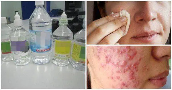 Hướng Dẫn Sử Dụng Nước Muối Sinh Lý Rửa Mặt: Lợi Ích Và Cách Thực Hiện Đúng
