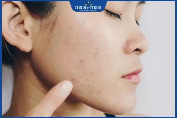 Mới Tẩy Nốt Ruồi Có Được Rửa Mặt Không? Thời Gian Kiêng Và Cách Chăm Sóc Mới Tẩy Nốt Ruồi Có Được Rửa Mặt Không? Thời Gian Kiêng Và Cách Chăm Sóc