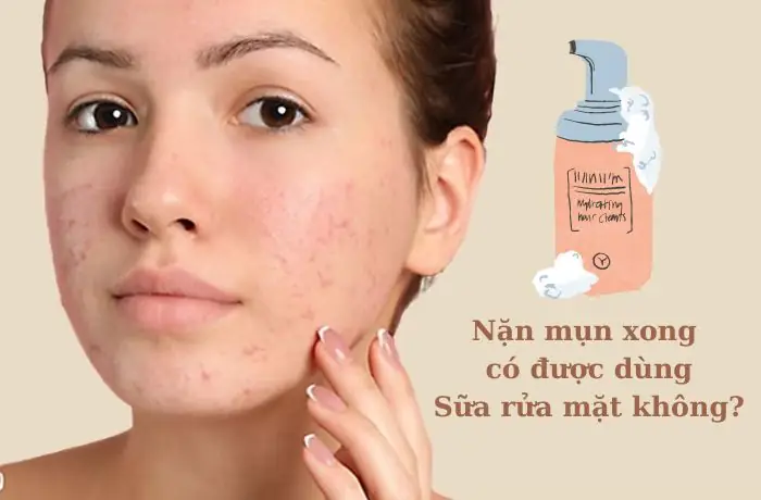 Nặn Mụn Xong Có Nên Dùng Sữa Rửa Mặt Không? Lưu Ý Quan Trọng Nặn Mụn Xong Có Nên Dùng Sữa Rửa Mặt Không? Lưu Ý Quan Trọng