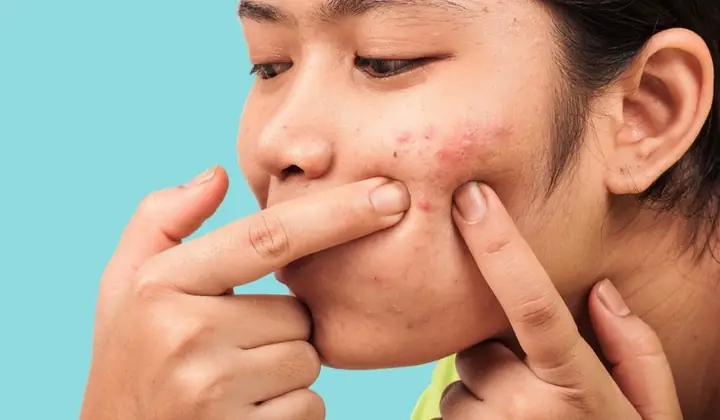 Nặn Mụn Xong Có Nên Rửa Mặt Bằng Nước Muối Sinh Lý Không?