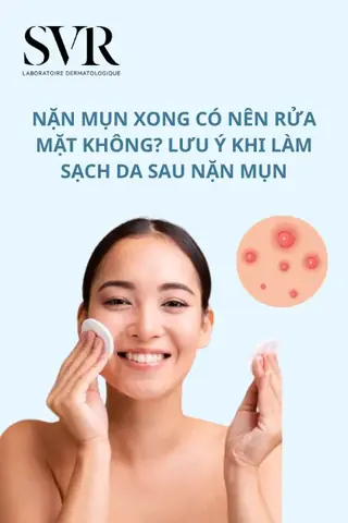 Nặn Mụn Xong Có Nên Rửa Mặt Không? Giải Đáp & Hướng Dẫn Chăm Sóc Da Chuẩn Nặn Mụn Xong Có Nên Rửa Mặt Không? Giải Đáp & Hướng Dẫn Chăm Sóc Da Chuẩn