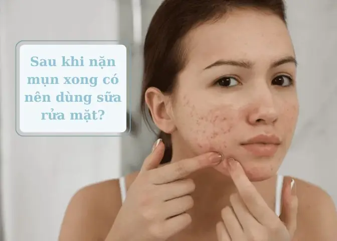 Nặn Mụn Xong Có Nên Rửa Mặt Không? Giải Đáp & Hướng Dẫn Chăm Sóc Da Chuẩn Nặn Mụn Xong Có Nên Rửa Mặt Không? Giải Đáp & Hướng Dẫn Chăm Sóc Da Chuẩn