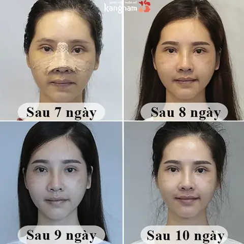 Nhấn Mí Bao Lâu Thì Được Rửa Mặt? Hướng Dẫn Chăm Sóc Chi Tiết Nhấn Mí Bao Lâu Thì Được Rửa Mặt? Hướng Dẫn Chăm Sóc Chi Tiết