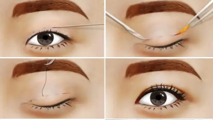 Nhấn Mí Bao Lâu Thì Được Rửa Mặt? Hướng Dẫn Chăm Sóc Chi Tiết Nhấn Mí Bao Lâu Thì Được Rửa Mặt? Hướng Dẫn Chăm Sóc Chi Tiết