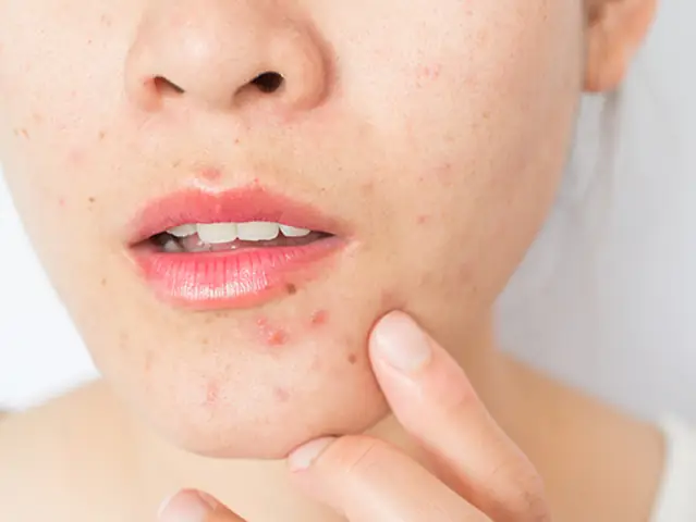 Top 5+ Thành Phần "hại Sức Khỏe" Cần Tránh Trong Sữa Rửa Mặt