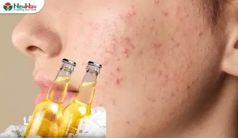 Rửa Mặt Bằng Bia Có Tốt Không? Tác Dụng, Cách Làm Và Lưu Ý Cho Da Rửa Mặt Bằng Bia Có Tốt Không? Tác Dụng, Cách Làm Và Lưu Ý Cho Da