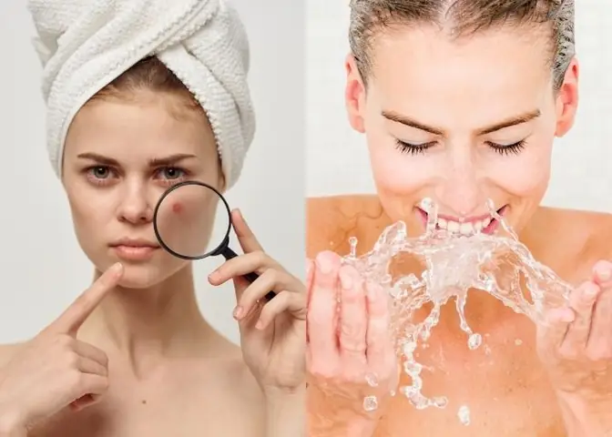 Rửa Mặt Nhiều Có Hết Mụn Không? Tần Suất Đúng & Cách Chăm Sóc Da Mụn Hiệu Quả