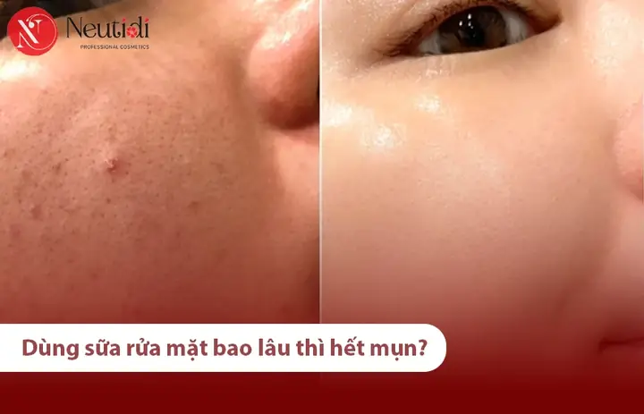 Rửa Mặt Đúng Cách Để Hết Mụn: Hướng Dẫn Từng Bước Cho Da Mụn