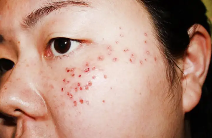 Sau Khi Đốt Tàn Nhang Có Nên Rửa Mặt Không? Hướng Dẫn Chăm Sóc Da Chi Tiết Sau Khi Đốt Tàn Nhang Có Nên Rửa Mặt Không? Hướng Dẫn Chăm Sóc Da Chi Tiết