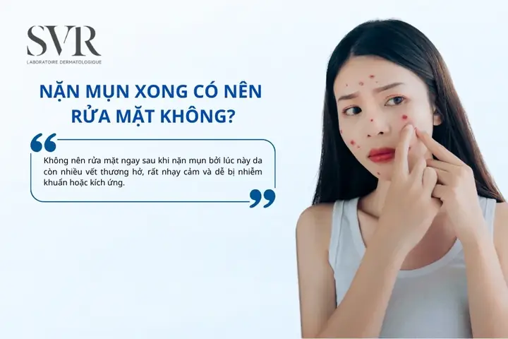 Sau Khi Nặn Mụn Có Nên Rửa Mặt Không? Hướng Dẫn Chăm Sóc Da Đúng Cách Sau Khi Nặn Mụn Có Nên Rửa Mặt Không? Hướng Dẫn Chăm Sóc Da Đúng Cách