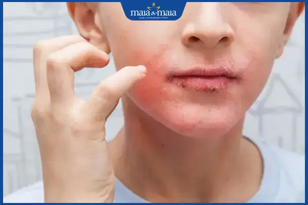 Sữa Rửa Mặt Cho Viêm Da Cơ Địa: Tiêu Chí Chọn Lọc & Gợi Ý Sản Phẩm An Toàn Sữa Rửa Mặt Cho Viêm Da Cơ Địa: Tiêu Chí Chọn Lọc & Gợi Ý Sản Phẩm An Toàn