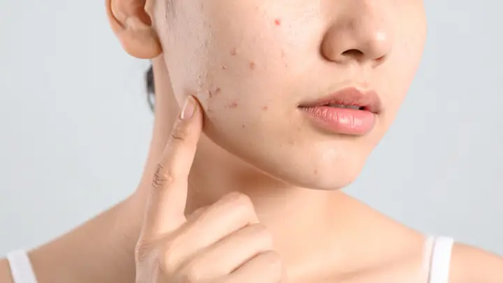 Sữa Rửa Mặt La Roche-posay Có Đẩy Mụn Không: Giải Đáp Chi Tiết Cho Da Mụn Sữa Rửa Mặt La Roche-posay Có Đẩy Mụn Không: Giải Đáp Chi Tiết Cho Da Mụn