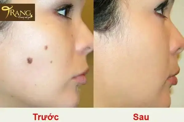 Tẩy Nốt Ruồi Bao Lâu Thì Được Rửa Mặt? Thời Gian Kiêng & Chăm Sóc Tẩy Nốt Ruồi Bao Lâu Thì Được Rửa Mặt? Thời Gian Kiêng & Chăm Sóc