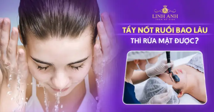 Tẩy Nốt Ruồi Bao Lâu Thì Được Rửa Mặt? Thời Gian Kiêng & Chăm Sóc Tẩy Nốt Ruồi Bao Lâu Thì Được Rửa Mặt? Thời Gian Kiêng & Chăm Sóc