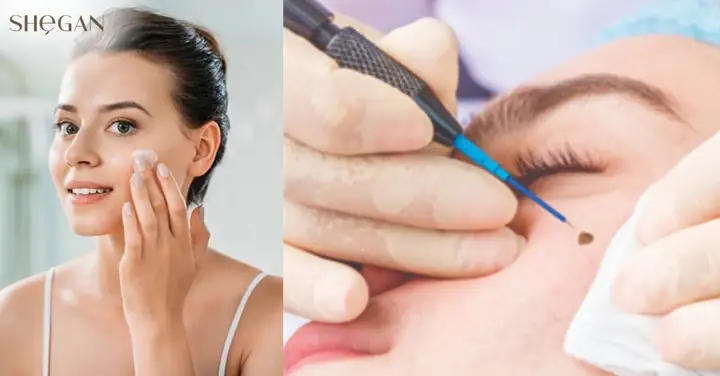 Tẩy Nốt Ruồi Bao Lâu Thì Được Rửa Mặt & Chăm Sóc Da Đúng Cách