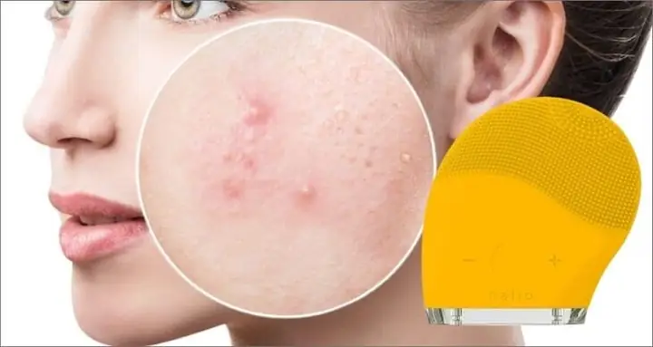 Xài Máy Rửa Mặt Bị Nổi Mụn: Nguyên Nhân, Cách Khắc Phục & Khi Nào Nên Dừng Lại Xài Máy Rửa Mặt Bị Nổi Mụn: Nguyên Nhân, Cách Khắc Phục & Khi Nào Nên Dừng Lại