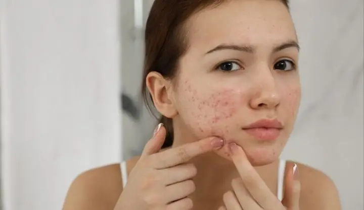 Xài Sữa Rửa Mặt Bị Mụn: Nguyên Nhân, Dấu Hiệu & Cách Khắc Phục Hiệu Quả Xài Sữa Rửa Mặt Bị Mụn: Nguyên Nhân, Dấu Hiệu & Cách Khắc Phục Hiệu Quả